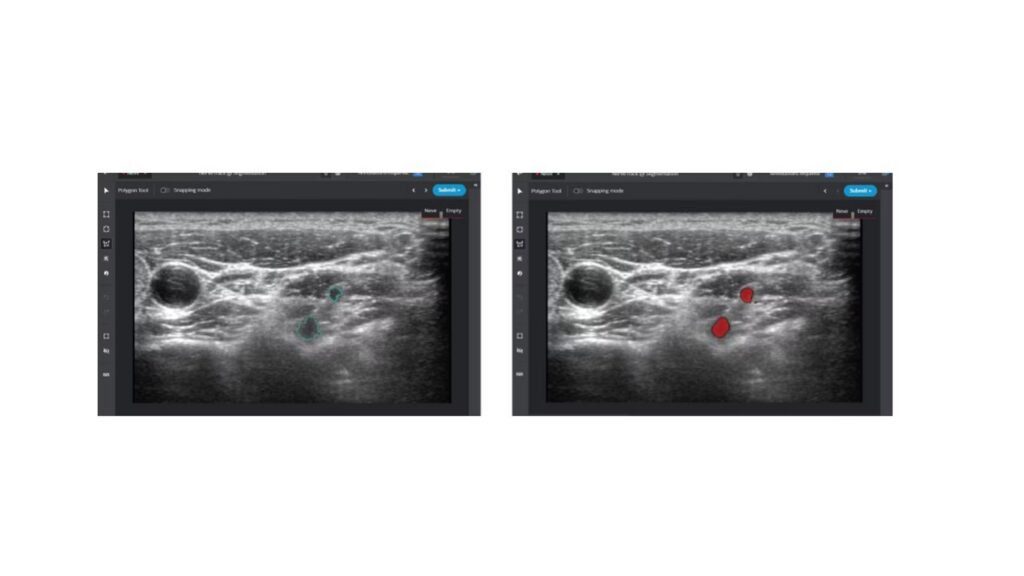 The image on the left represents ground truth, the target of the NerveTrack machine learning model. The image at right is annotated with the Intel Geti platform for inference model training proof of concept, based on 13 annotated ultrasound images. The image on the left represents ground truth, the target of the NerveTrack machine learning model. The image at right is annotated with the Intel Geti platform for inference model training proof of concept, based on 13 annotated ultrasound images.